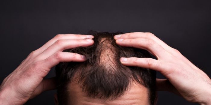 Hair Transplant Cost in 2024: What You Need to Know