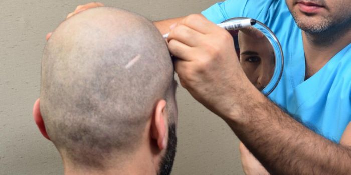 Exploring Hair Transplants in Turkey: A Detailed Guide