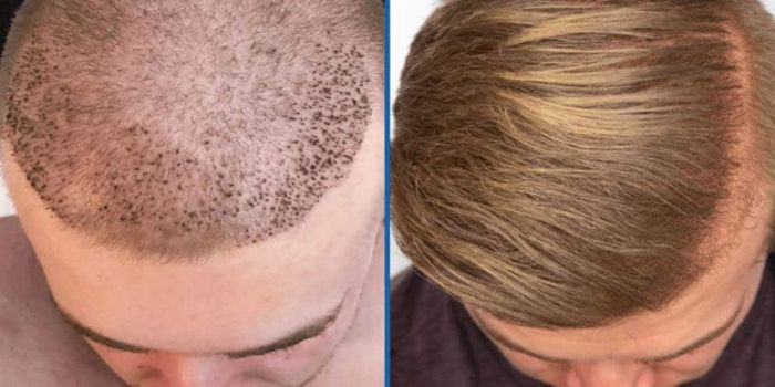 FUE vs. FUT: Which Hair Transplant Method is Right for You?