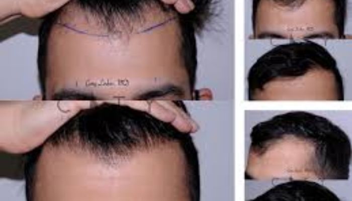Best Hair Transplant Options in NYC: A Quick Overview