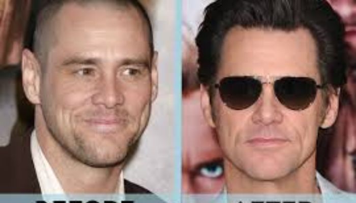 Celebrity Hair Transplants: Notable Transformations
