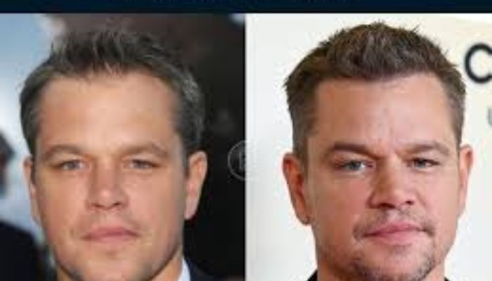 Celebrity Hair Transplants: Notable Transformations