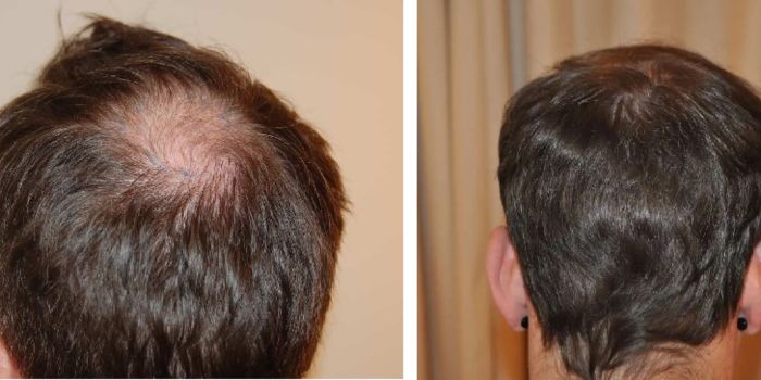 Comparing Minoxidil and Hair Transplants: What’s the Difference?
