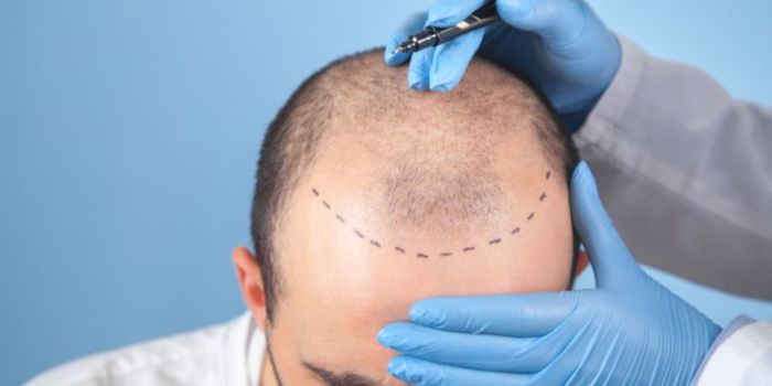 How Hair Transplants Work: The Basics Explained