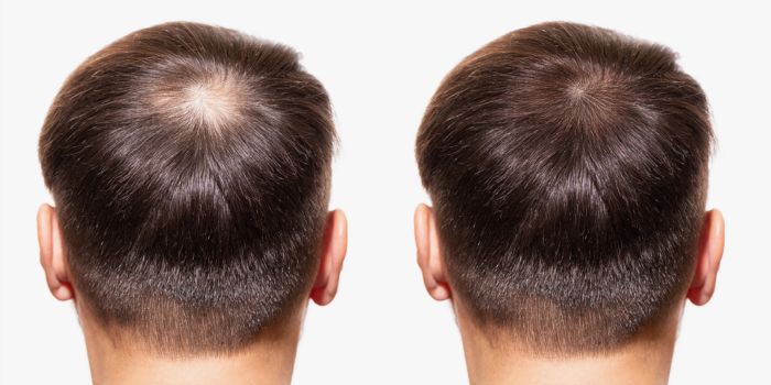 The Future of Hair Restoration: Stem Cell Transplants