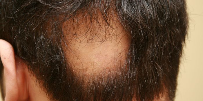 The Future of Hair Restoration: Stem Cell Transplants