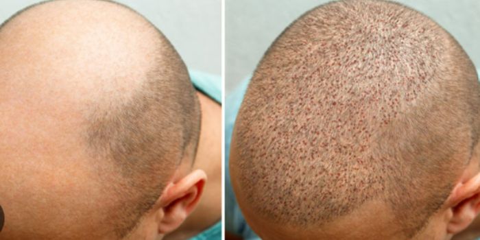 What to Expect During Hair Transplant Recovery: A Complete Guide