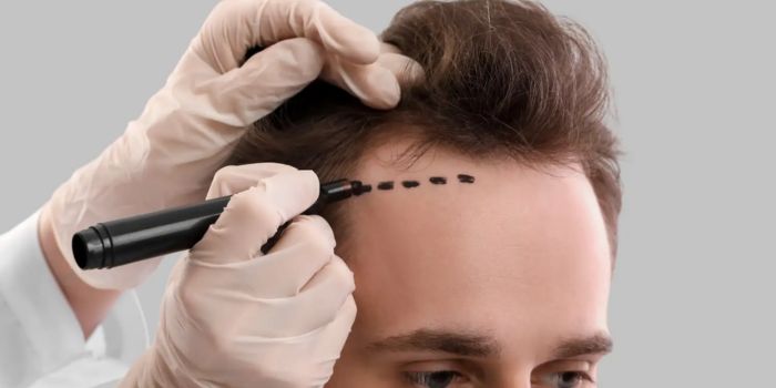 What to Expect During Hair Transplant Recovery: A Complete Guide