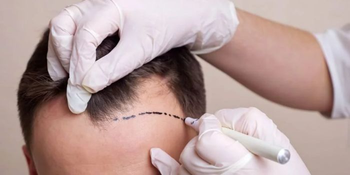 Different Types of Hair Transplant Techniques Explained