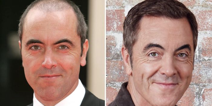 How Hair Transplants Have Influenced Celebrity Careers